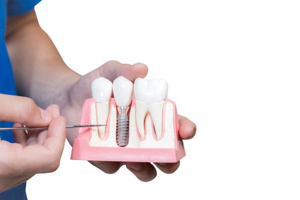 How long do dental implants take to heal?