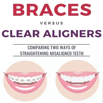 Aligners v/s Braces