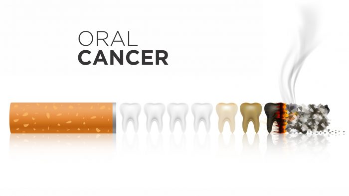 Screening Procedures- Oral Cancer