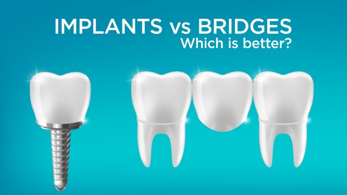Implants vs Bridges: Which is better?