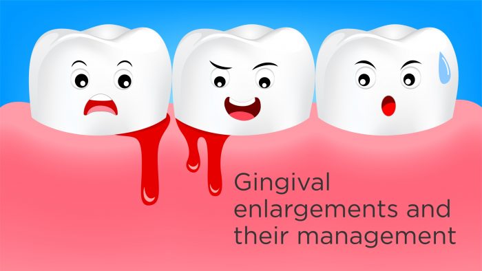 Gingival enlargements and their management