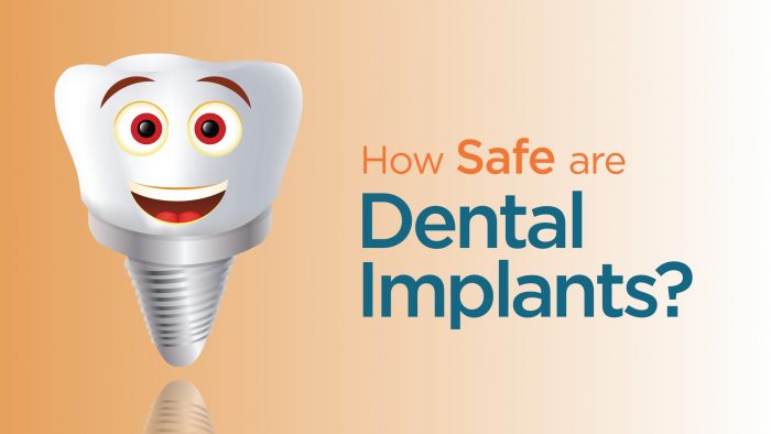 How SAFE are Dental Implants?