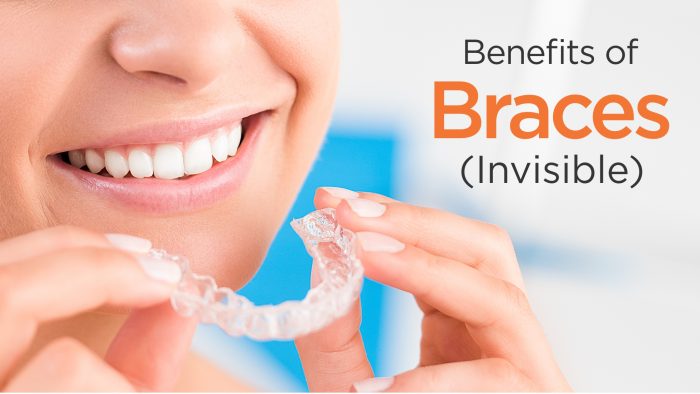 Benefits of Braces (Invisible)