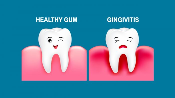Gingivitis in Children – Causes, Symptoms and Prevention