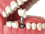Best Implantologists in Hyderabad - Top Implant dentists