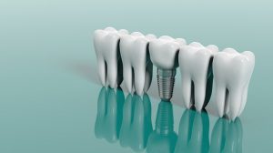 Where to get a dental implant in India?