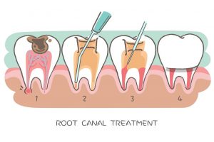 Everything you need to know about root canal treatment