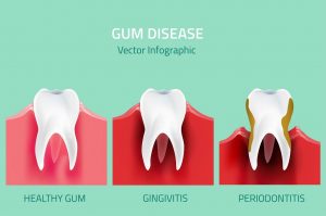 What is Gum Disease and How to Prevent Tooth Loss