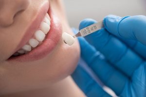 Facts You Need to Know Before Planning for Dental Crowns