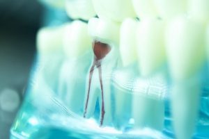 Is Root Canal Treatment Advisable in Children?