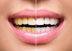 All You Need to Know About Teeth Whitening	

