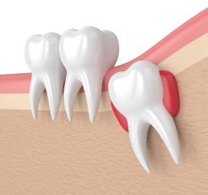Impacted Wisdom Teeth- Symptoms, Pain, & Removal	
