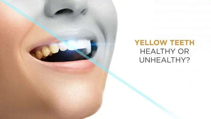 Yellow Teeth - Healthy or Unhealthy?