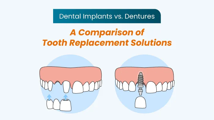 Dental Implants vs. Dentures: A Comparison of Tooth Replacement Solutions