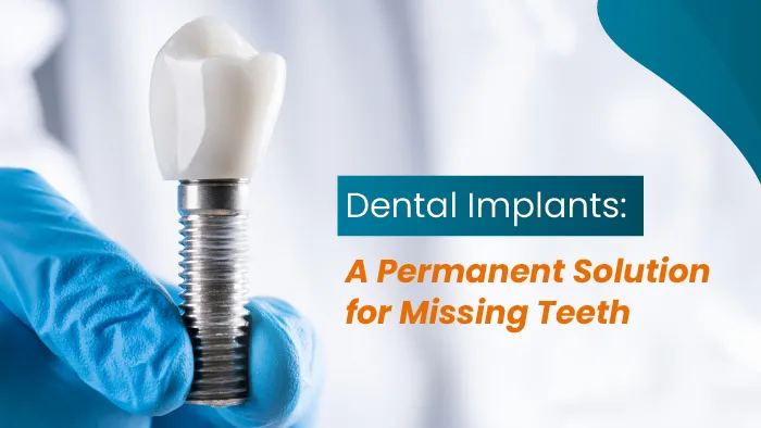 Dental Implants: A Permanent Solution for Missing Teeth