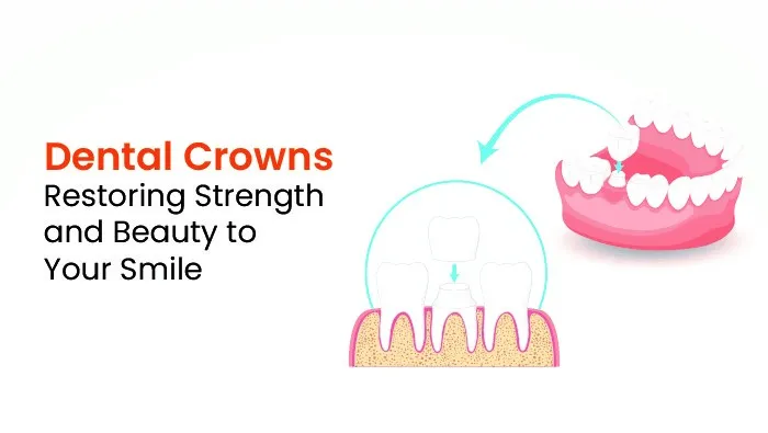 Dental Crowns: Restoring Strength and Beauty to Your Smile