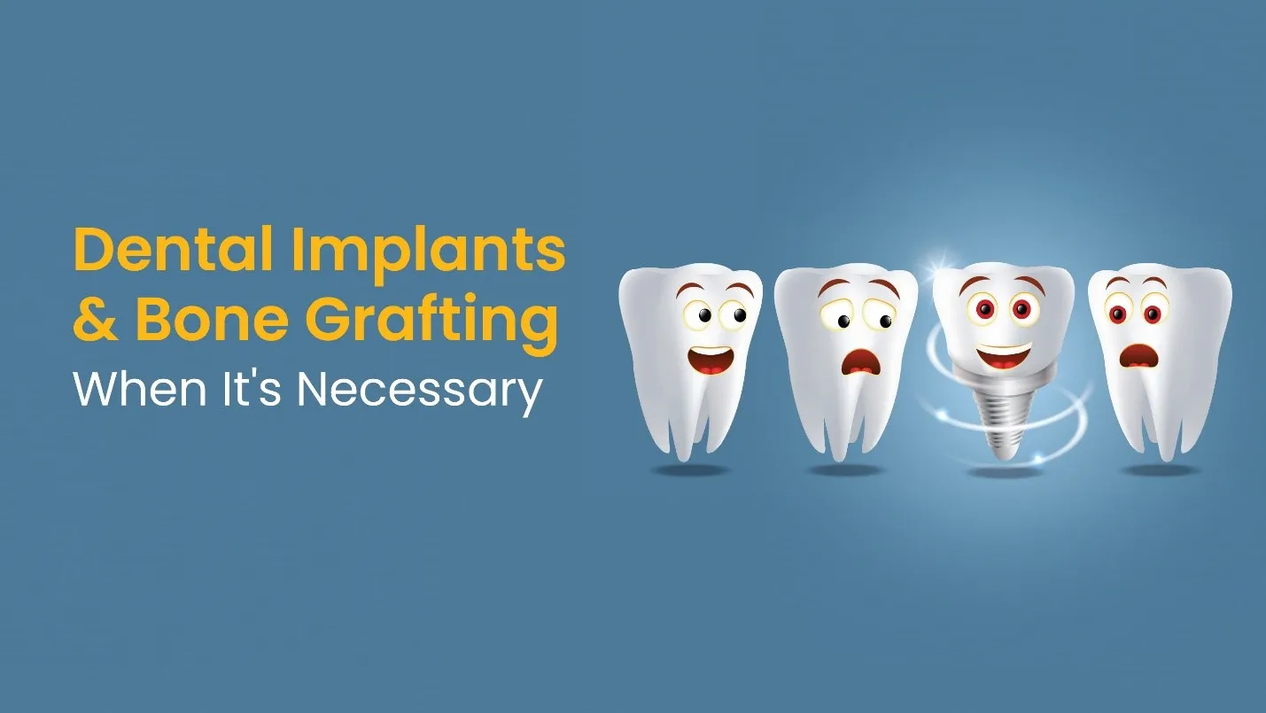 Dental Implants and Bone Grafting: When It's Necessary