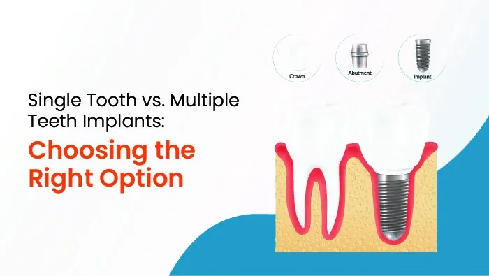 Single Tooth vs. Multiple Teeth Implants: Choosing the Right Option