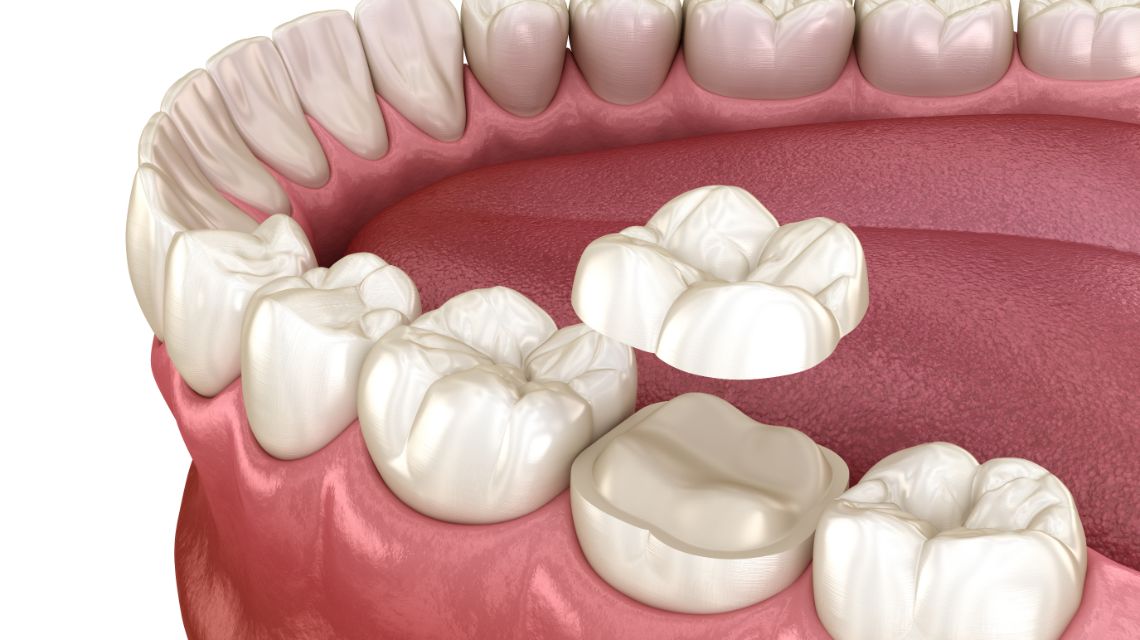 Tooth Colored Filling Img medium