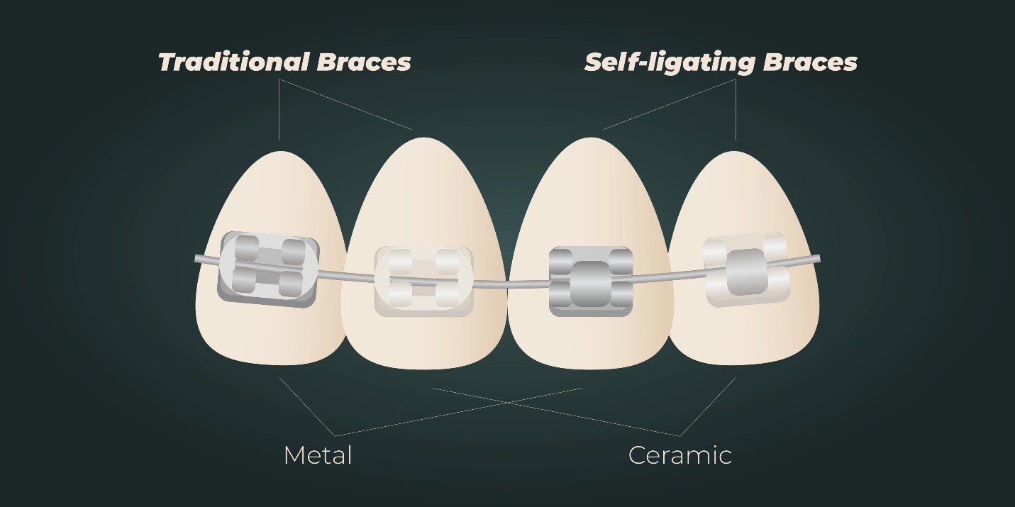 Self-ligating braces